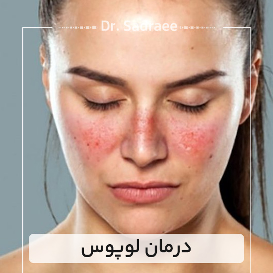 درمان لوپوس