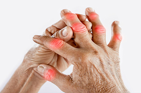 روماتیسم مفصلی